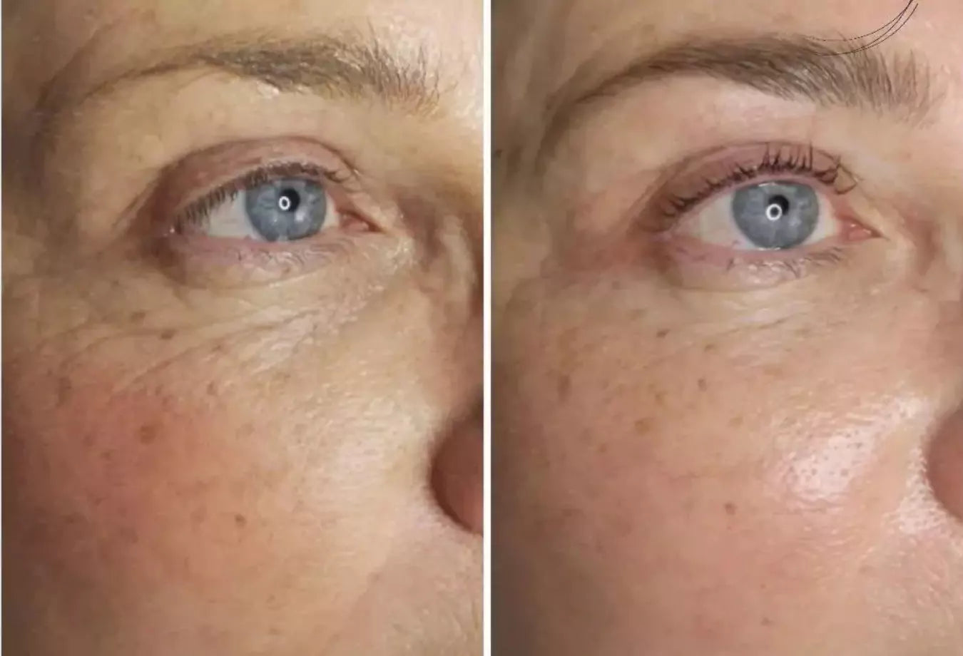 før og etter bilde - anti-age behandling 