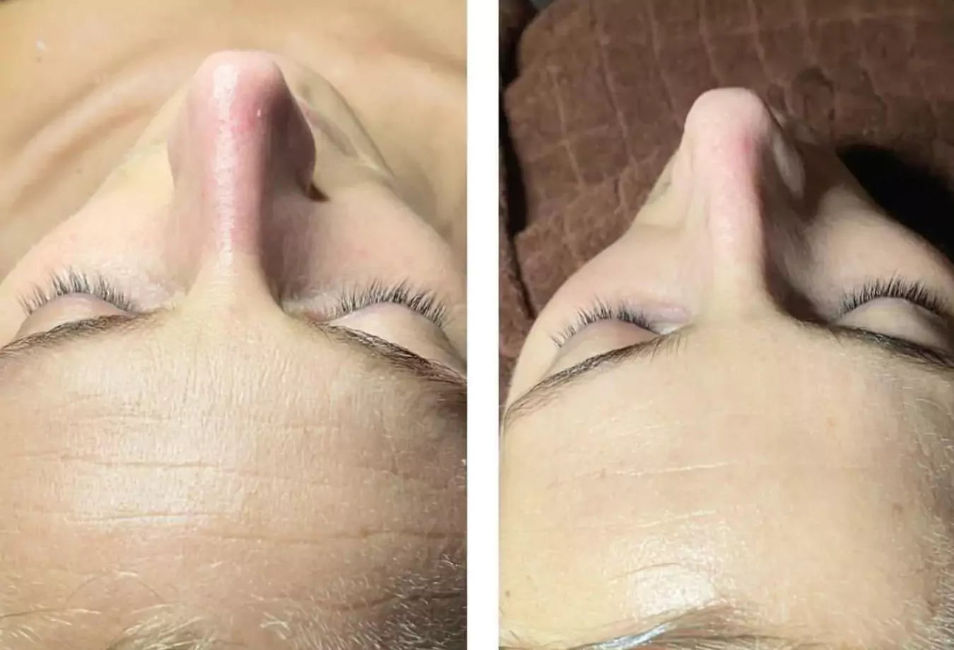 før og etter bilde etter kun 1 behandling med carboxy therapy