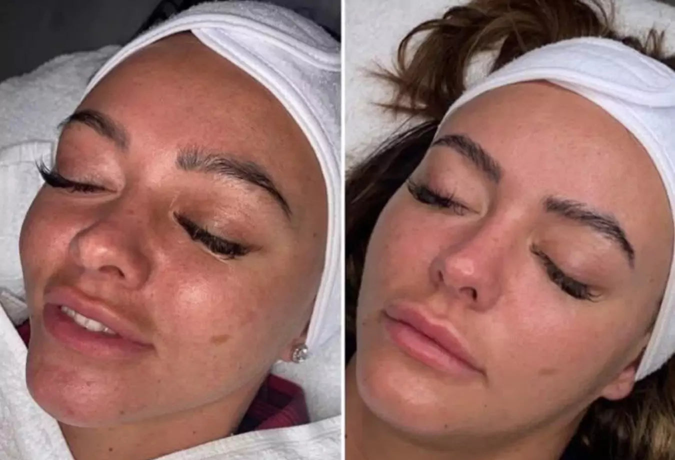 Før og etter bilde behandling cliniccare