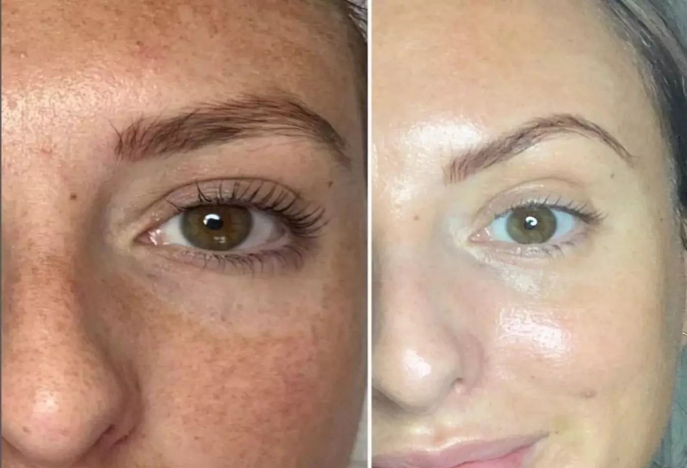 Før og etter bilder av kjemisk peeling og microneedling