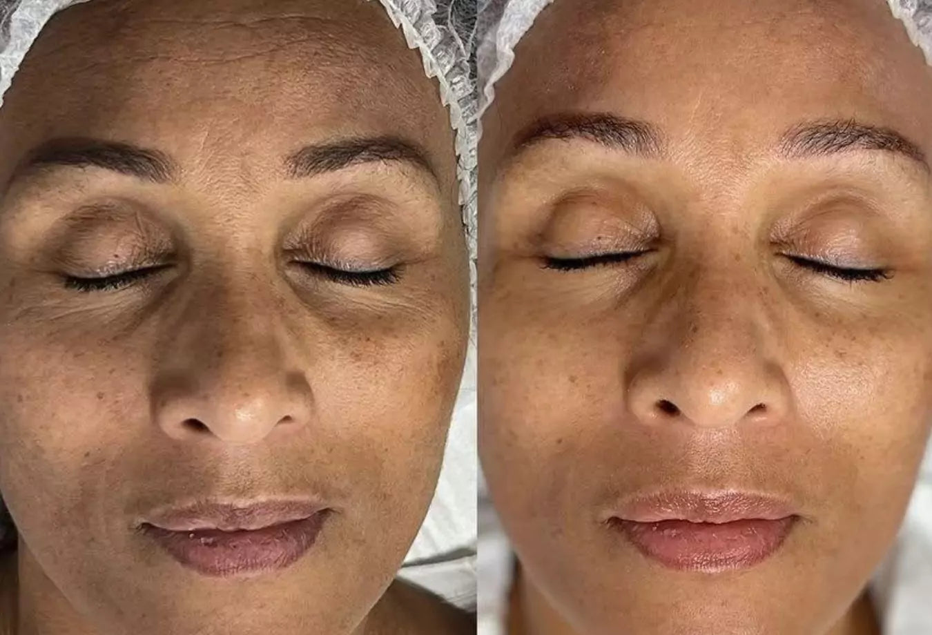 før og etter bilder microneedling og kjemisk peel 